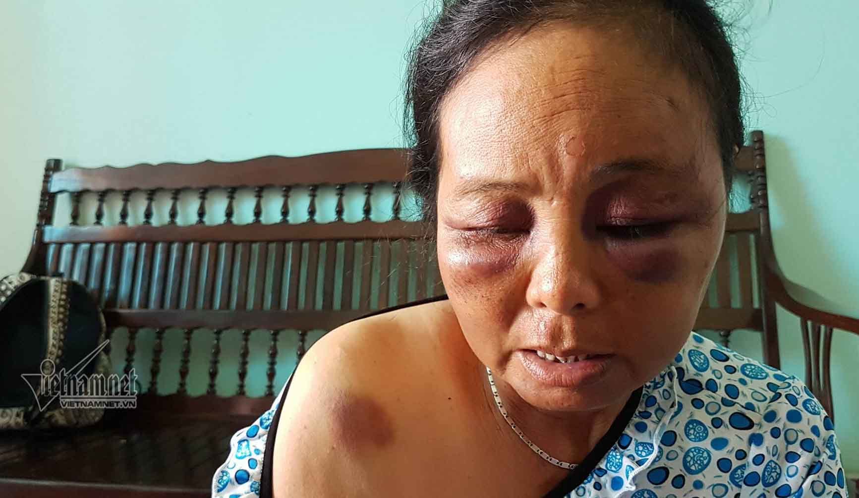 Bà bán tăm kể phút bị đánh bầm dập vì nghi bắt cóc trẻ em