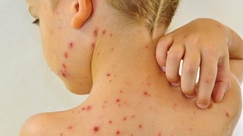 Bệnh thủy đậu là bệnh như thế nào?