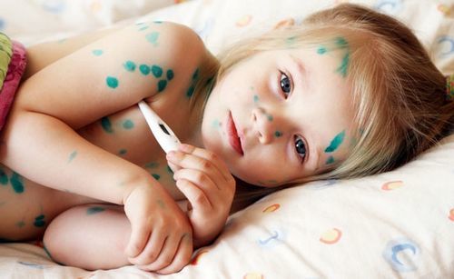 Chăm sóc người bệnh bị thủy đậu