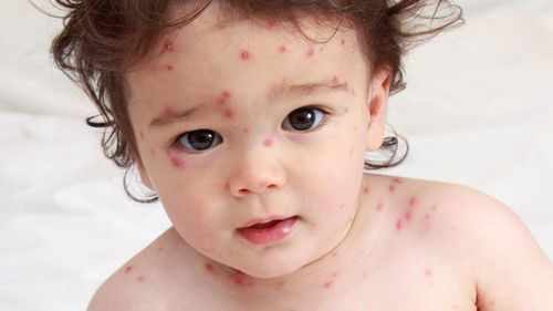 Dấu hiệu nhận biết khi trẻ mắc bệnh thủy đậu