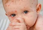Nguyên nhân và triệu chứng bệnh thủy đậu ở trẻ em