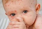 Nguyên nhân và triệu chứng bệnh thủy đậu ở trẻ em