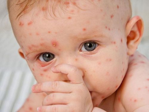 Nguyên nhân và triệu chứng bệnh thủy đậu ở trẻ em