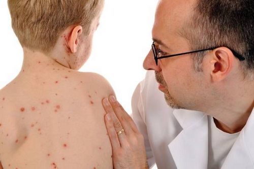 Nguyên tắc điều trị và phòng bệnh thủy đậu