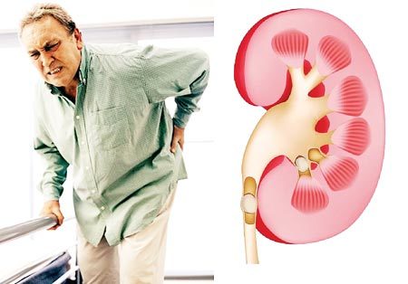 60% bệnh nhân sỏi thận tái phát