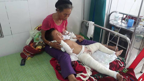 Nghịch xăng, bé 4 tuổi cháy xém từ bụng đến chân