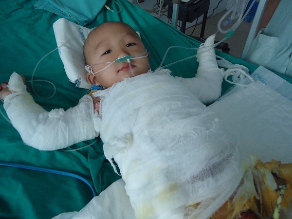 Con bỏng nặng, cha mẹ khánh kiệt không nơi bấu víu