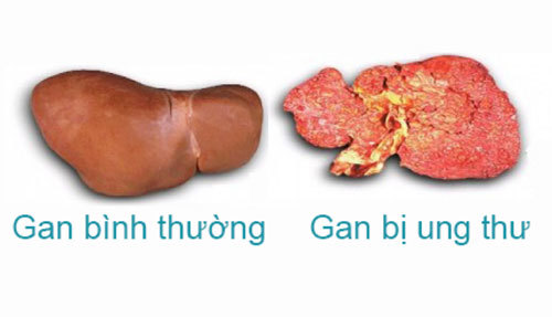 Bệnh ung thư gan được hiểu như thế nào?