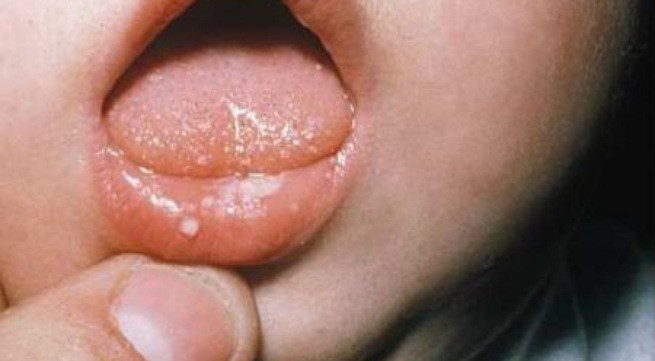 Trẻ mắc sùi mào gà có thể bị ung thư