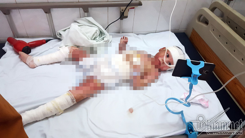 Bé gái 5 tuổi bỏng toàn thân kiên cường trải qua 5 lần phẫu thuật