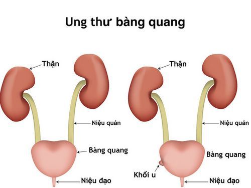 Điều trị ung thư bàng quang bằng cách nào?