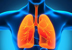 Tràn khí màng phổi, nguyên nhân và cách điều trị