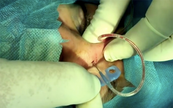 Biến chứng nâng mũi