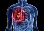Nguyên nhân nào dẫn đến bệnh ung thư phổi