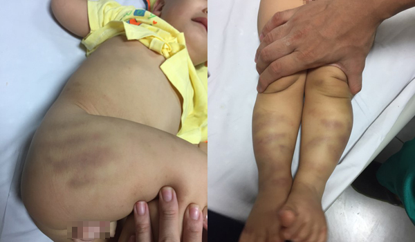 Bé bị bạo hành, bỏ lại bệnh viện phải thở oxy