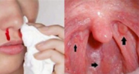 Ung thư vòm họng - 1 bệnh ung thư đứng đầu ở VN: 3 dấu hiệu phát hiện bệnh sớm cần nhớ
