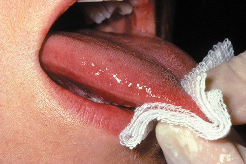 Làm thế nào để nhận biết bệnh ung thư lưỡi?