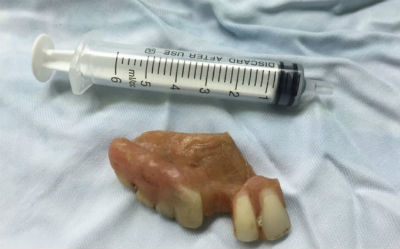 Hàm răng giả bị bỏ quên 2 năm trong cổ họng