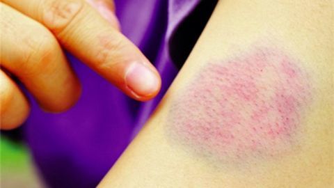 Dấu hiệu của bệnh ung thư bạch cầu