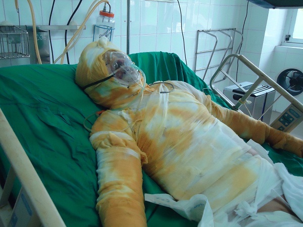 Chồng bỏng điện nguy kịch, vợ bán hết lợn giống lo không đủ