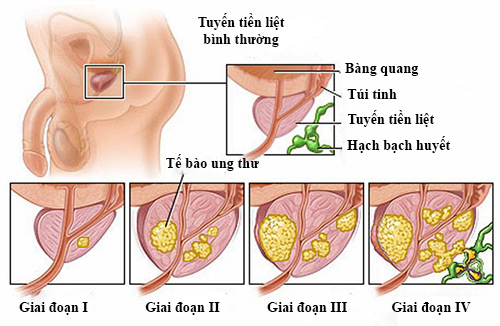 Các giai đoạn của bệnh ung thư tiền liệt tuyến