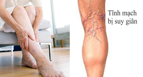 3 việc cần làm khi có triệu chứng suy giãn tĩnh mạch