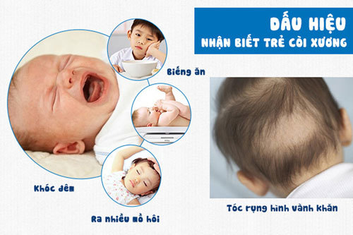 Những điều nên biết về bệnh còi xương ở trẻ em