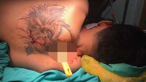 Nam thanh niên bị bạn gái đâm thủng phổi