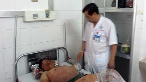 Bếp cồn cháy dữ dội, 11 người đang ăn tiệc cưới bị bỏng