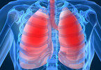 Điều trị bệnh viêm phổi