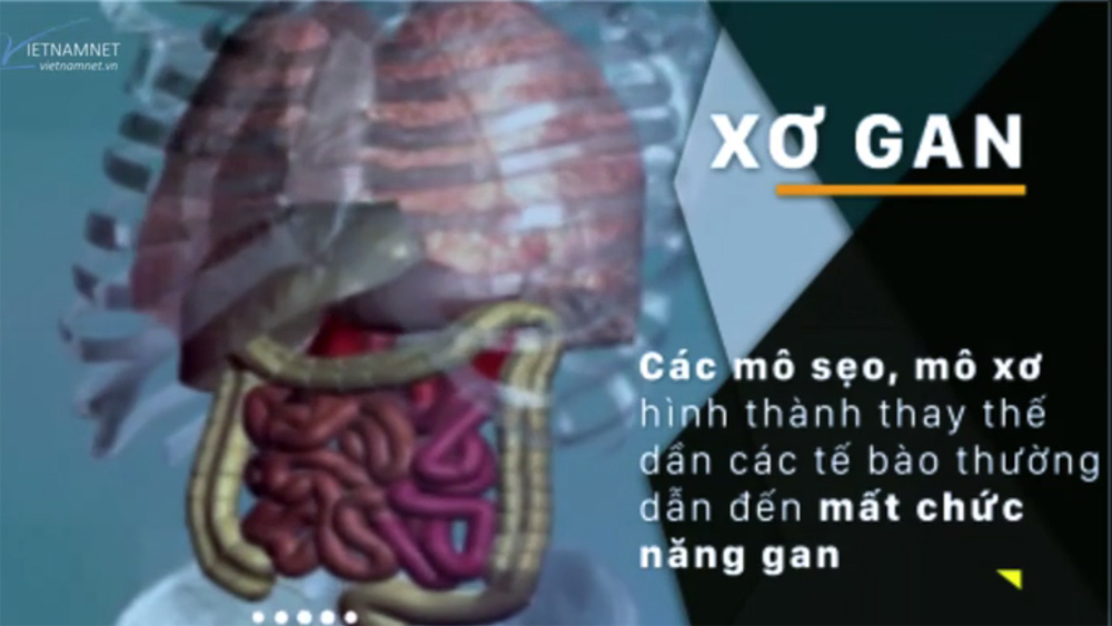 'Sát thủ giấu mặt' gây xơ gan