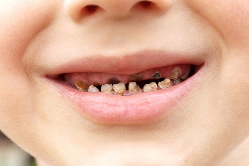 7 loại thực phẩm thúc đẩy quá trình sâu răng