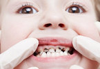 4 bệnh về răng miệng phổ biến ở Việt Nam