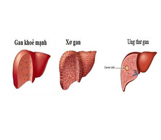 Bệnh gan tại Việt Nam