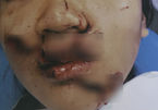 Nữ sinh Sài Gòn rách nát mặt khi ngã vào cửa kính