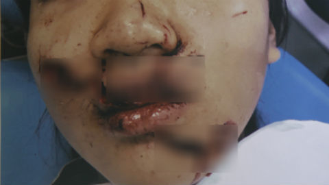 Nữ sinh Sài Gòn rách nát mặt khi ngã vào cửa kính