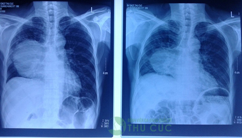 Ung thư phổi? Đừng vội bỏ cuộc