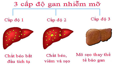Dấu hiệu gan nhiễm mỡ, cảnh báo không thể bỏ qua