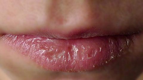 Mẹo giúp đôi môi nứt nẻ trở nên mịn màng