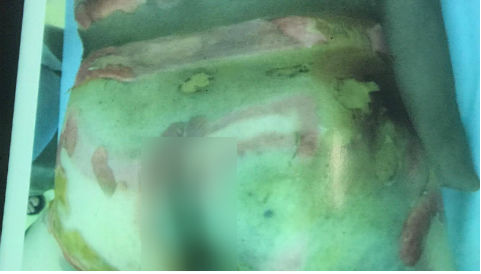 Bỏng 'cậu nhỏ' khi bật lửa trong túi quần phát nổ