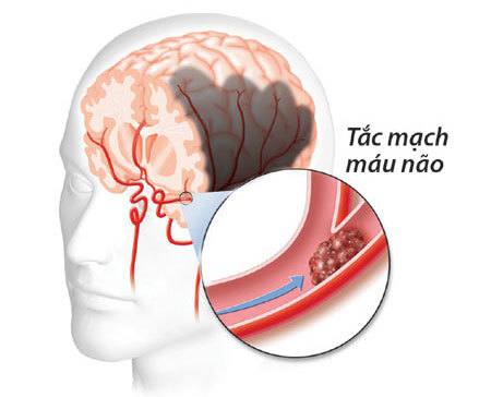 Khi mạch máu não “kẹt xe”
