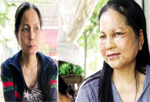 Cô gái 'hóa bà lão' lại bị lão hóa lần thứ 2