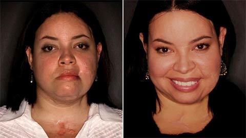 Cô gái bị chém hơn 100 nhát có khuôn mặt mới