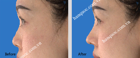 Nâng mũi S line tại Thẩm mỹ Hàn Quốc