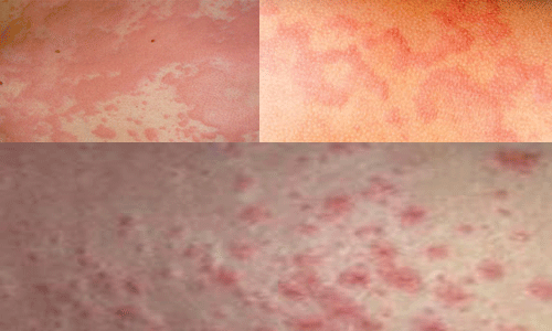 Khám, tư vấn miễn phí bệnh dị ứng