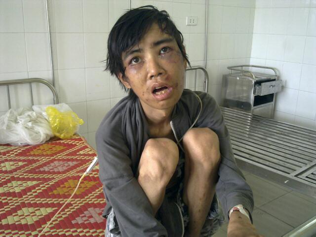 Bị đánh tơi tả vì trộm cắp và dọa truyền nhiễm HIV
