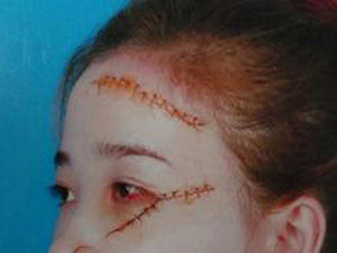 Ghen tuông, thiếu nữ 20 rạch mặt nữ sinh 17