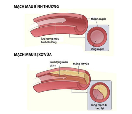 Mạch máu xơ vữa, não gặp nguy