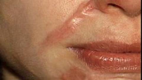 Nữ sinh 13 tuổi bị bạn rạch mặt vì ghen