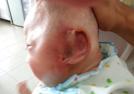 Những người bị dòi ăn da thịt hy hữu ở Việt Nam